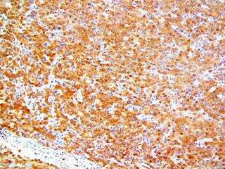IHC of SMAD4 on a FFPE Pancreatic Cancer Tissue